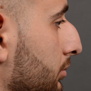 rhinoplasty Nothing demonstrates the skillful craftsmanship that Dr. Oakley Smith accomplishes during his surgeries than a collection of before and after case studies. As one of a hand full of surgeons in North America who limits his practice to only Rhinoplasty surgery, it is obvious that he has mastered his art. There is no question why he is one of the busiest cosmetic nose job surgeons in the country.