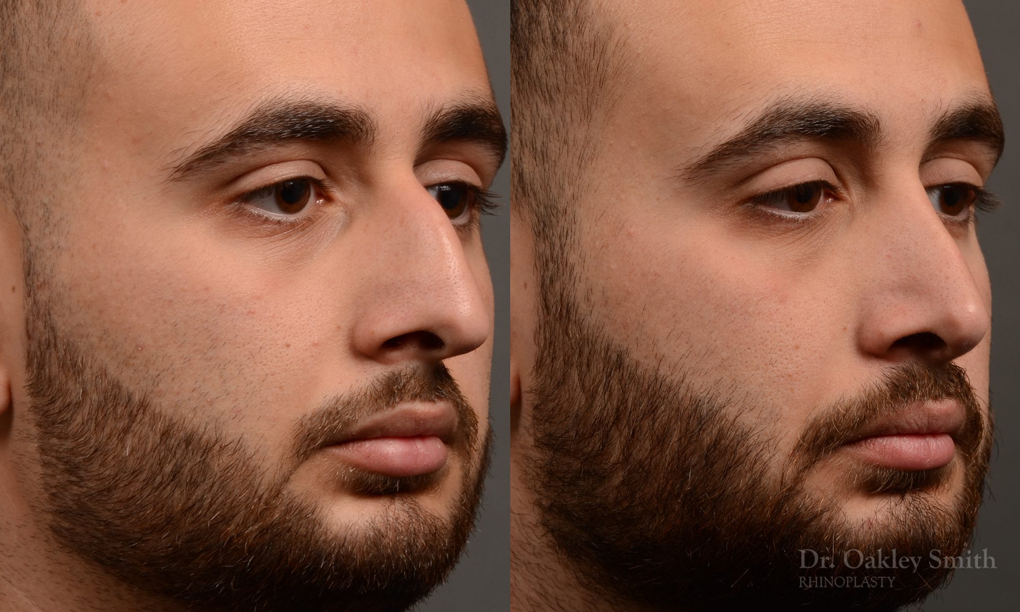 rhinoplasty Nothing demonstrates the skillful craftsmanship that Dr. Oakley Smith accomplishes during his surgeries than a collection of before and after case studies. As one of a hand full of surgeons in North America who limits his practice to only Rhinoplasty surgery, it is obvious that he has mastered his art. There is no question why he is one of the busiest cosmetic nose job surgeons in the country.