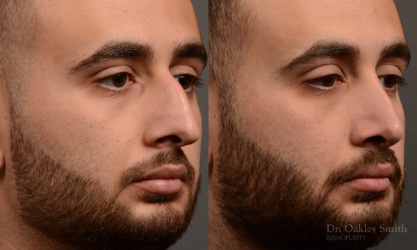 rhinoplasty Nothing demonstrates the skillful craftsmanship that Dr. Oakley Smith accomplishes during his surgeries than a collection of before and after case studies. As one of a hand full of surgeons in North America who limits his practice to only Rhinoplasty surgery, it is obvious that he has mastered his art. There is no question why he is one of the busiest cosmetic nose job surgeons in the country.