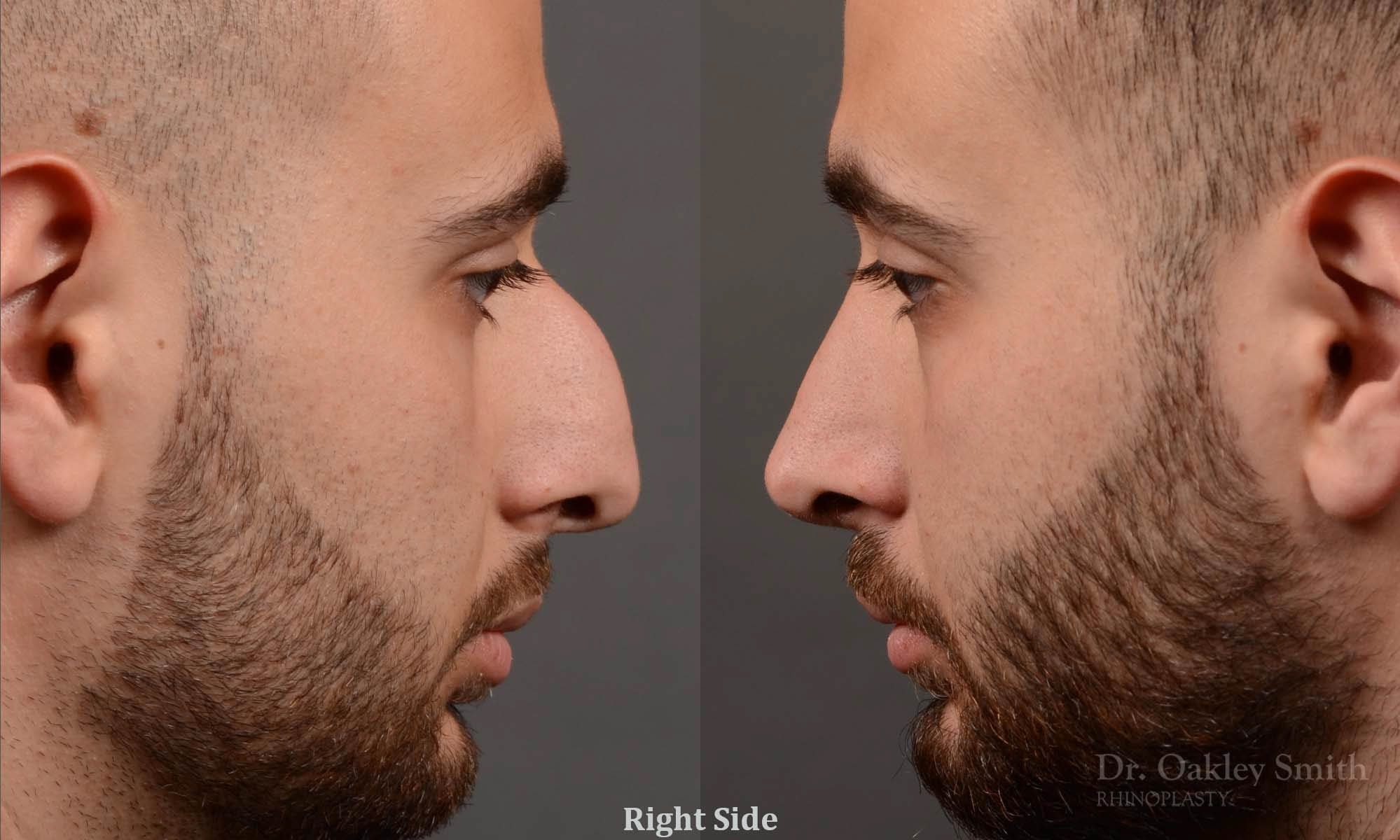 rhinoplasty Nothing demonstrates the skillful craftsmanship that Dr. Oakley Smith accomplishes during his surgeries than a collection of before and after case studies. As one of a hand full of surgeons in North America who limits his practice to only Rhinoplasty surgery, it is obvious that he has mastered his art. There is no question why he is one of the busiest cosmetic nose job surgeons in the country.