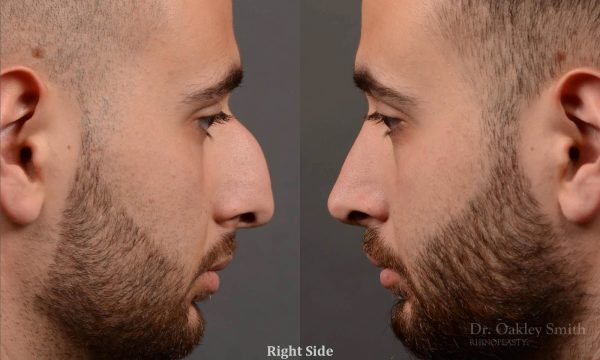rhinoplasty Nothing demonstrates the skillful craftsmanship that Dr. Oakley Smith accomplishes during his surgeries than a collection of before and after case studies. As one of a hand full of surgeons in North America who limits his practice to only Rhinoplasty surgery, it is obvious that he has mastered his art. There is no question why he is one of the busiest cosmetic nose job surgeons in the country.