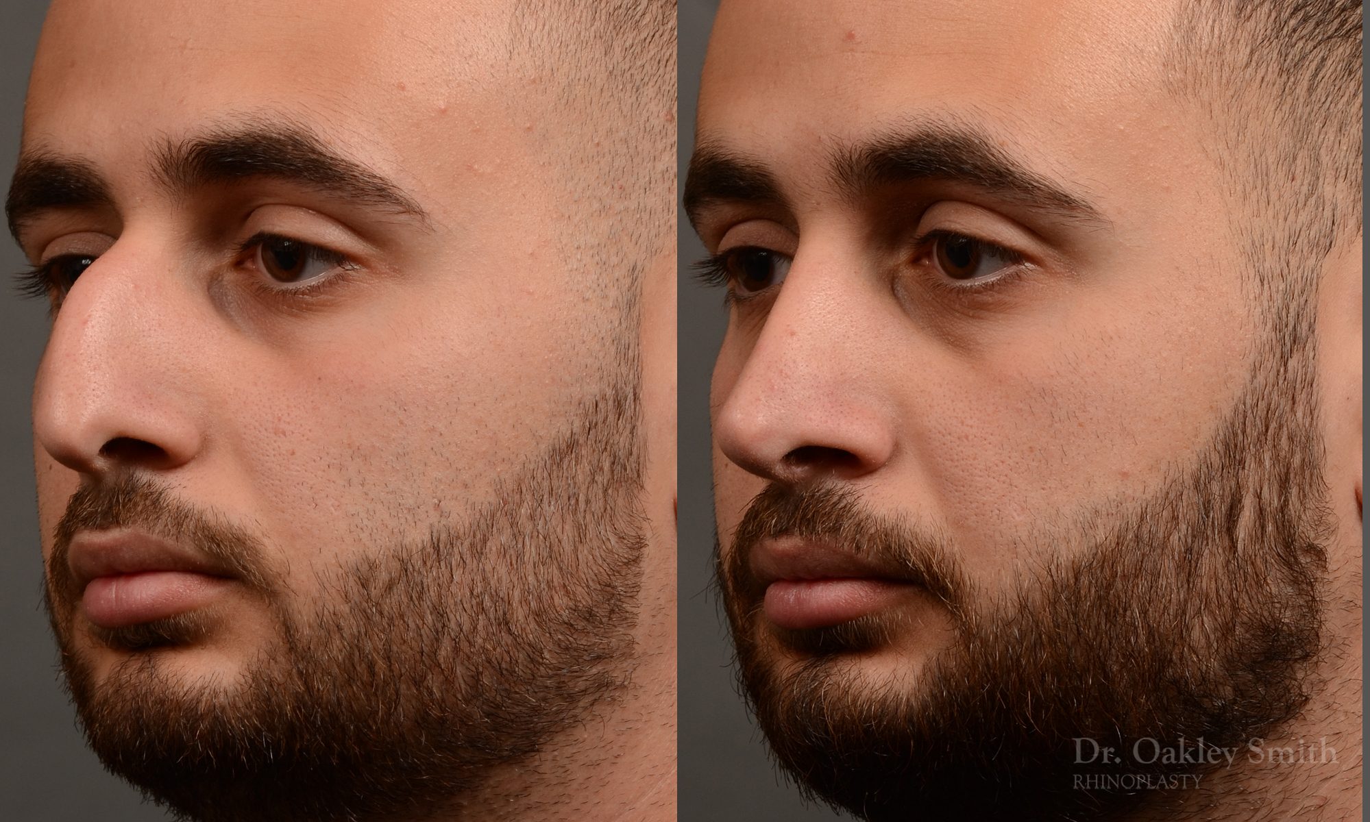 rhinoplasty Nothing demonstrates the skillful craftsmanship that Dr. Oakley Smith accomplishes during his surgeries than a collection of before and after case studies. As one of a hand full of surgeons in North America who limits his practice to only Rhinoplasty surgery, it is obvious that he has mastered his art. There is no question why he is one of the busiest cosmetic nose job surgeons in the country.