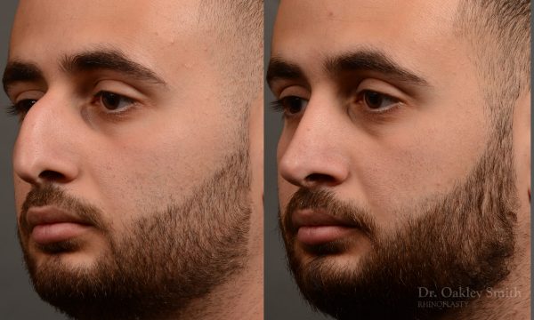 rhinoplasty Nothing demonstrates the skillful craftsmanship that Dr. Oakley Smith accomplishes during his surgeries than a collection of before and after case studies. As one of a hand full of surgeons in North America who limits his practice to only Rhinoplasty surgery, it is obvious that he has mastered his art. There is no question why he is one of the busiest cosmetic nose job surgeons in the country.