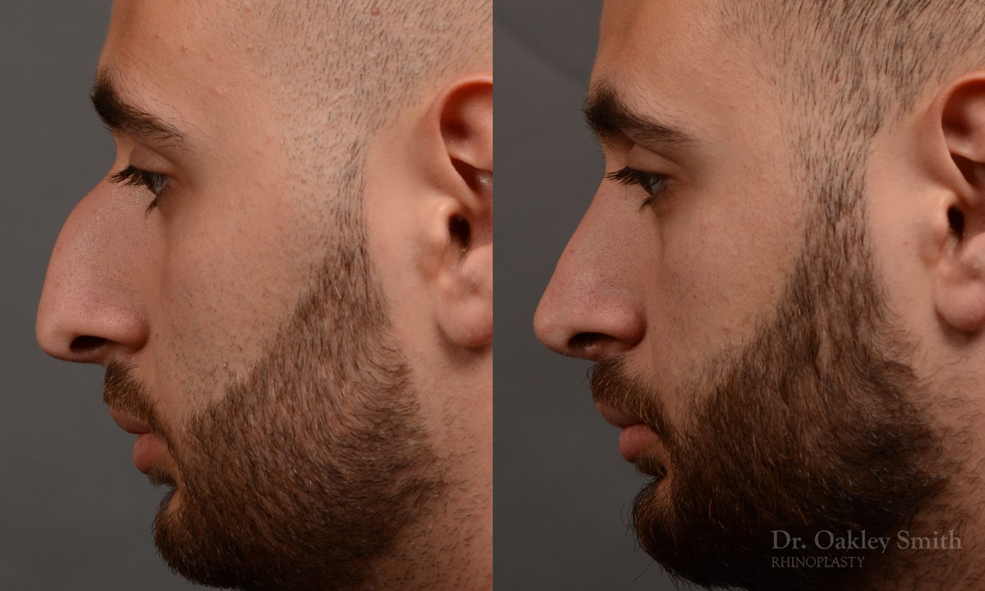 rhinoplasty Nothing demonstrates the skillful craftsmanship that Dr. Oakley Smith accomplishes during his surgeries than a collection of before and after case studies. As one of a hand full of surgeons in North America who limits his practice to only Rhinoplasty surgery, it is obvious that he has mastered his art. There is no question why he is one of the busiest cosmetic nose job surgeons in the country.