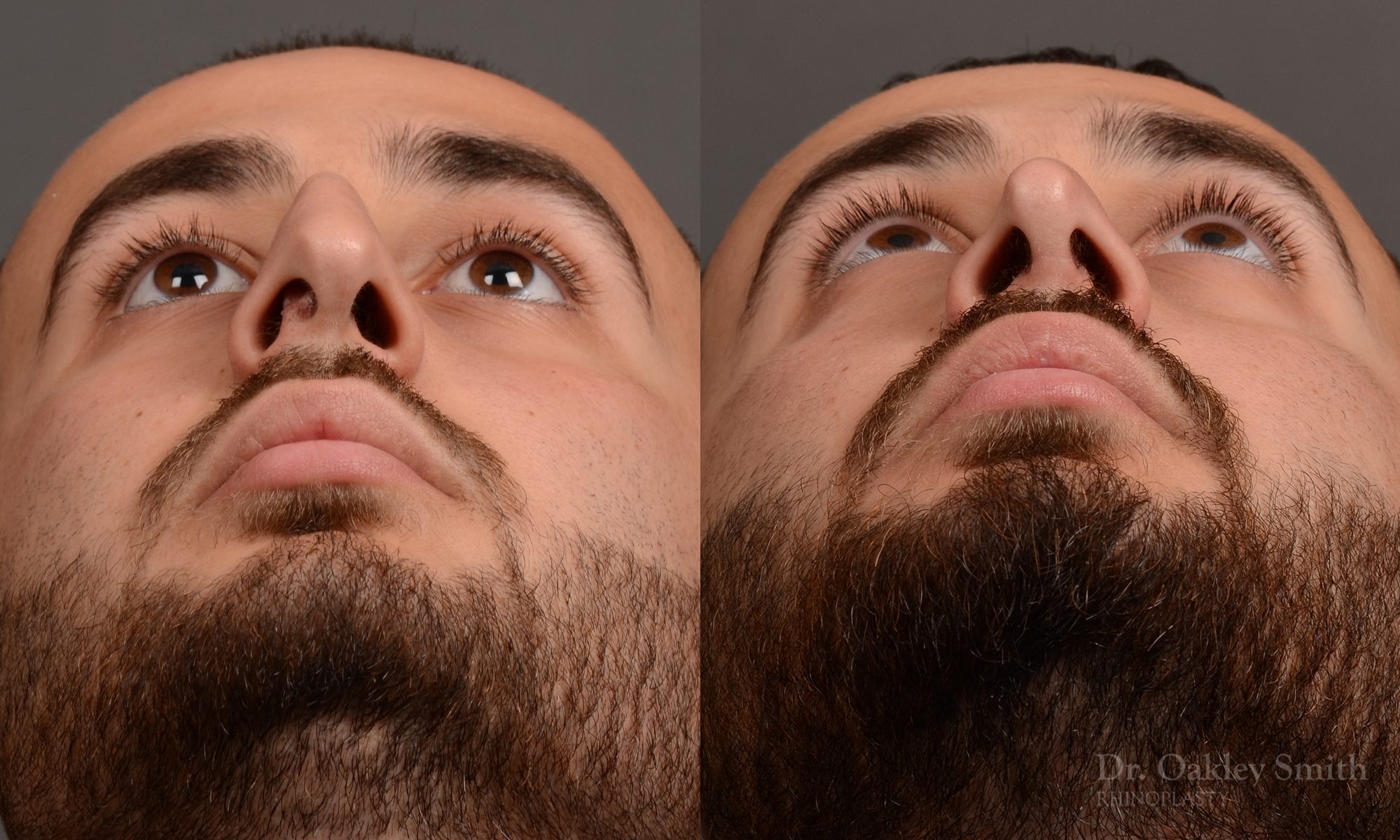 rhinoplasty Nothing demonstrates the skillful craftsmanship that Dr. Oakley Smith accomplishes during his surgeries than a collection of before and after case studies. As one of a hand full of surgeons in North America who limits his practice to only Rhinoplasty surgery, it is obvious that he has mastered his art. There is no question why he is one of the busiest cosmetic nose job surgeons in the country.