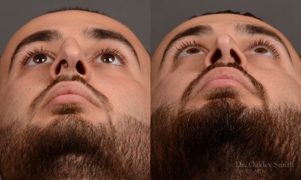 rhinoplasty Nothing demonstrates the skillful craftsmanship that Dr. Oakley Smith accomplishes during his surgeries than a collection of before and after case studies. As one of a hand full of surgeons in North America who limits his practice to only Rhinoplasty surgery, it is obvious that he has mastered his art. There is no question why he is one of the busiest cosmetic nose job surgeons in the country.