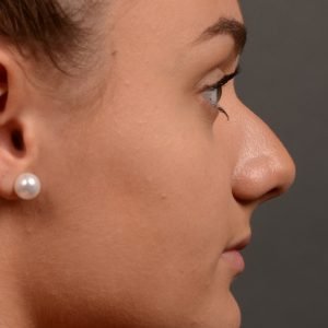 rhinoplasty Nothing demonstrates the skillful craftsmanship that Dr. Oakley Smith accomplishes during his surgeries than a collection of before and after case studies. As one of a hand full of surgeons in North America who limits his practice to only Rhinoplasty surgery, it is obvious that he has mastered his art. There is no question why he is one of the busiest cosmetic nose job surgeons in the country.