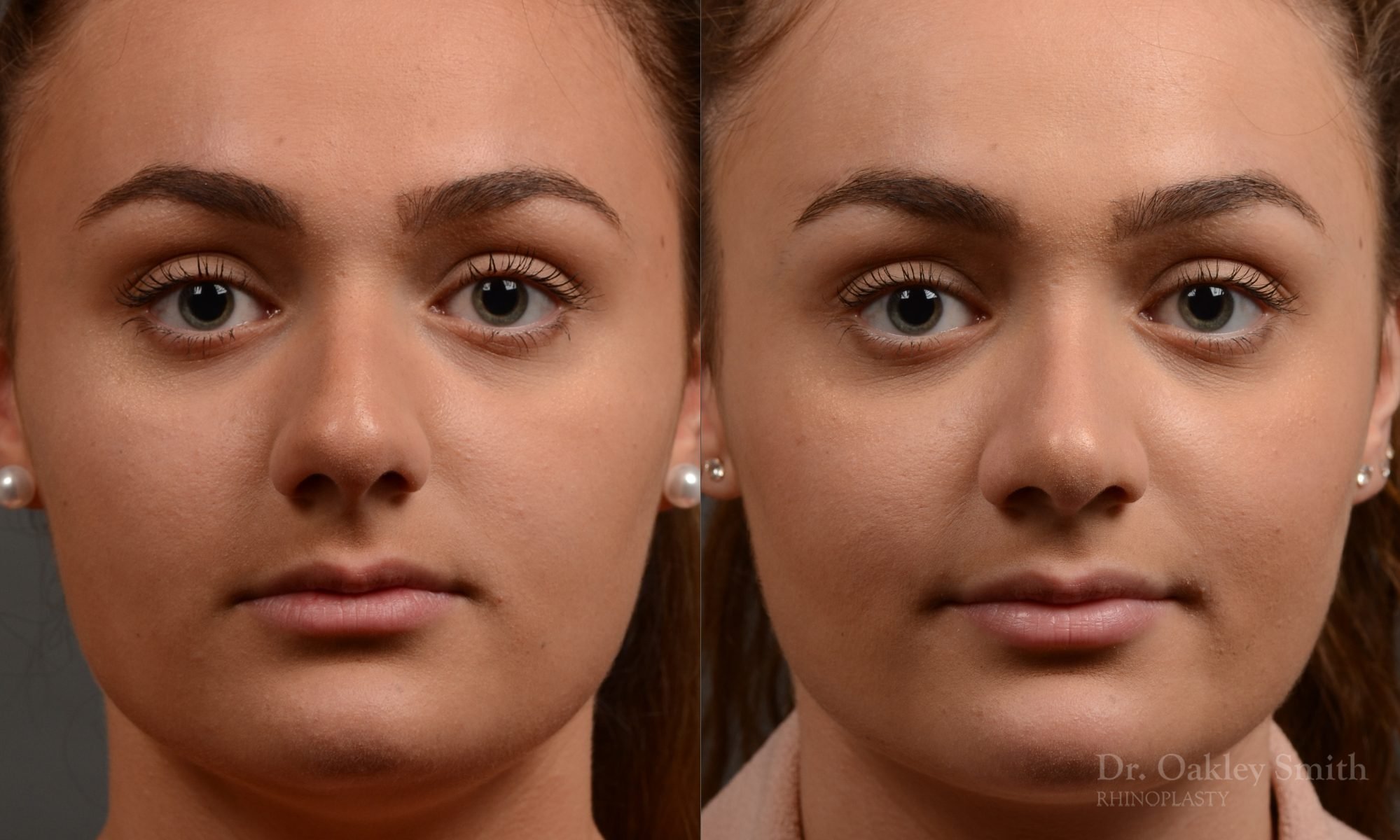 rhinoplasty Nothing demonstrates the skillful craftsmanship that Dr. Oakley Smith accomplishes during his surgeries than a collection of before and after case studies. As one of a hand full of surgeons in North America who limits his practice to only Rhinoplasty surgery, it is obvious that he has mastered his art. There is no question why he is one of the busiest cosmetic nose job surgeons in the country.