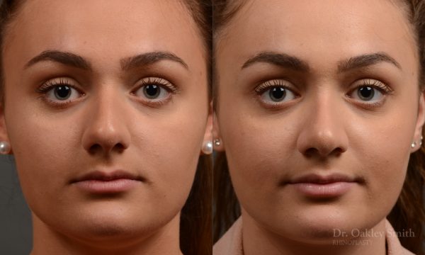 rhinoplasty Nothing demonstrates the skillful craftsmanship that Dr. Oakley Smith accomplishes during his surgeries than a collection of before and after case studies. As one of a hand full of surgeons in North America who limits his practice to only Rhinoplasty surgery, it is obvious that he has mastered his art. There is no question why he is one of the busiest cosmetic nose job surgeons in the country.