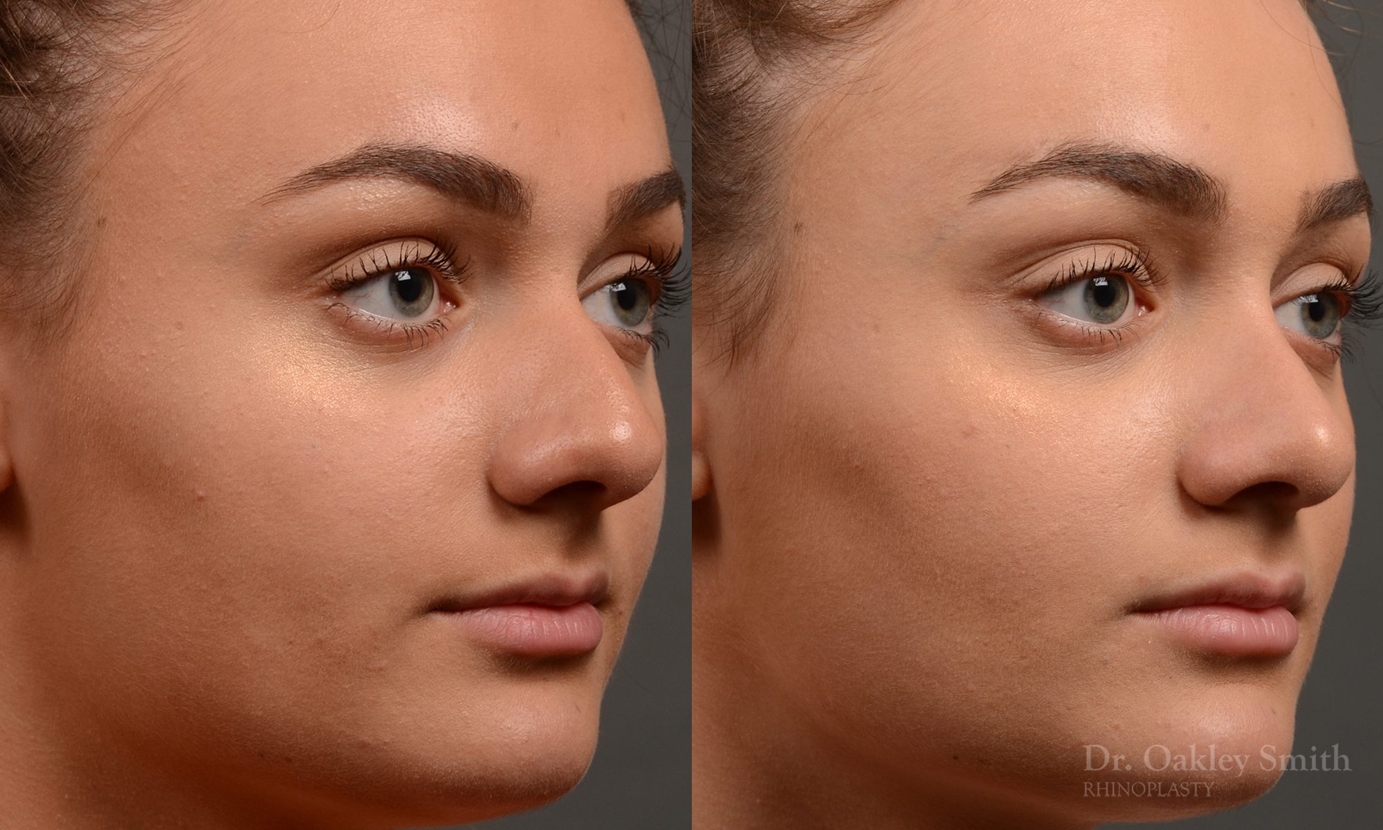 rhinoplasty Nothing demonstrates the skillful craftsmanship that Dr. Oakley Smith accomplishes during his surgeries than a collection of before and after case studies. As one of a hand full of surgeons in North America who limits his practice to only Rhinoplasty surgery, it is obvious that he has mastered his art. There is no question why he is one of the busiest cosmetic nose job surgeons in the country.