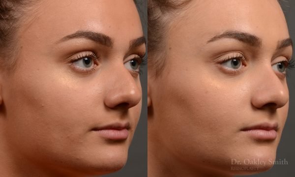 rhinoplasty Nothing demonstrates the skillful craftsmanship that Dr. Oakley Smith accomplishes during his surgeries than a collection of before and after case studies. As one of a hand full of surgeons in North America who limits his practice to only Rhinoplasty surgery, it is obvious that he has mastered his art. There is no question why he is one of the busiest cosmetic nose job surgeons in the country.