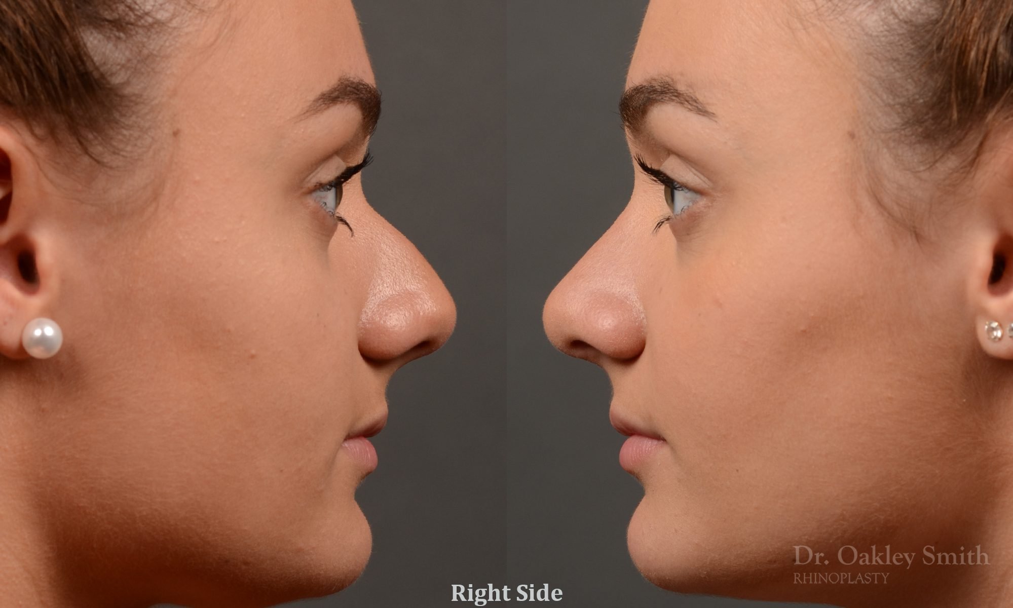rhinoplasty Nothing demonstrates the skillful craftsmanship that Dr. Oakley Smith accomplishes during his surgeries than a collection of before and after case studies. As one of a hand full of surgeons in North America who limits his practice to only Rhinoplasty surgery, it is obvious that he has mastered his art. There is no question why he is one of the busiest cosmetic nose job surgeons in the country.