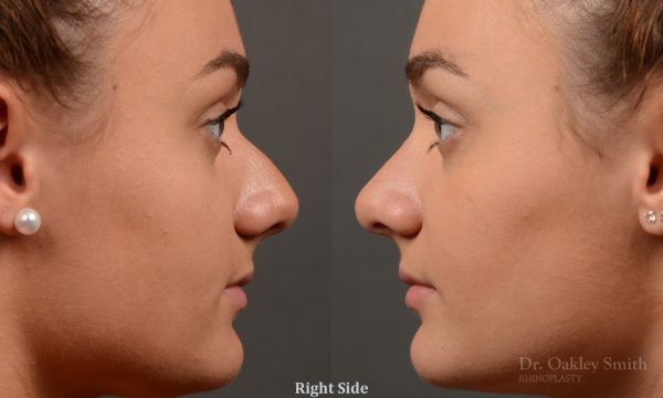 rhinoplasty Nothing demonstrates the skillful craftsmanship that Dr. Oakley Smith accomplishes during his surgeries than a collection of before and after case studies. As one of a hand full of surgeons in North America who limits his practice to only Rhinoplasty surgery, it is obvious that he has mastered his art. There is no question why he is one of the busiest cosmetic nose job surgeons in the country.