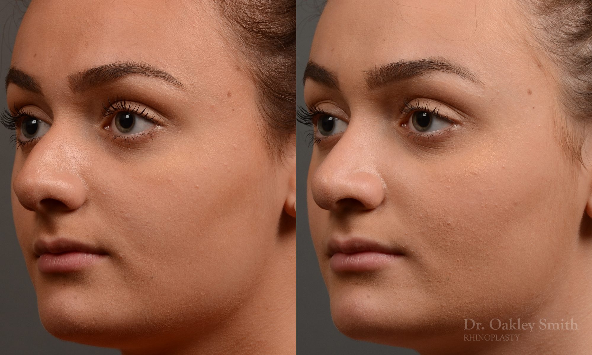 rhinoplasty Nothing demonstrates the skillful craftsmanship that Dr. Oakley Smith accomplishes during his surgeries than a collection of before and after case studies. As one of a hand full of surgeons in North America who limits his practice to only Rhinoplasty surgery, it is obvious that he has mastered his art. There is no question why he is one of the busiest cosmetic nose job surgeons in the country.