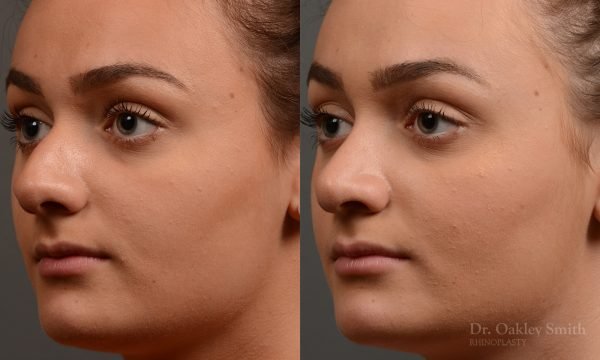 rhinoplasty Nothing demonstrates the skillful craftsmanship that Dr. Oakley Smith accomplishes during his surgeries than a collection of before and after case studies. As one of a hand full of surgeons in North America who limits his practice to only Rhinoplasty surgery, it is obvious that he has mastered his art. There is no question why he is one of the busiest cosmetic nose job surgeons in the country.