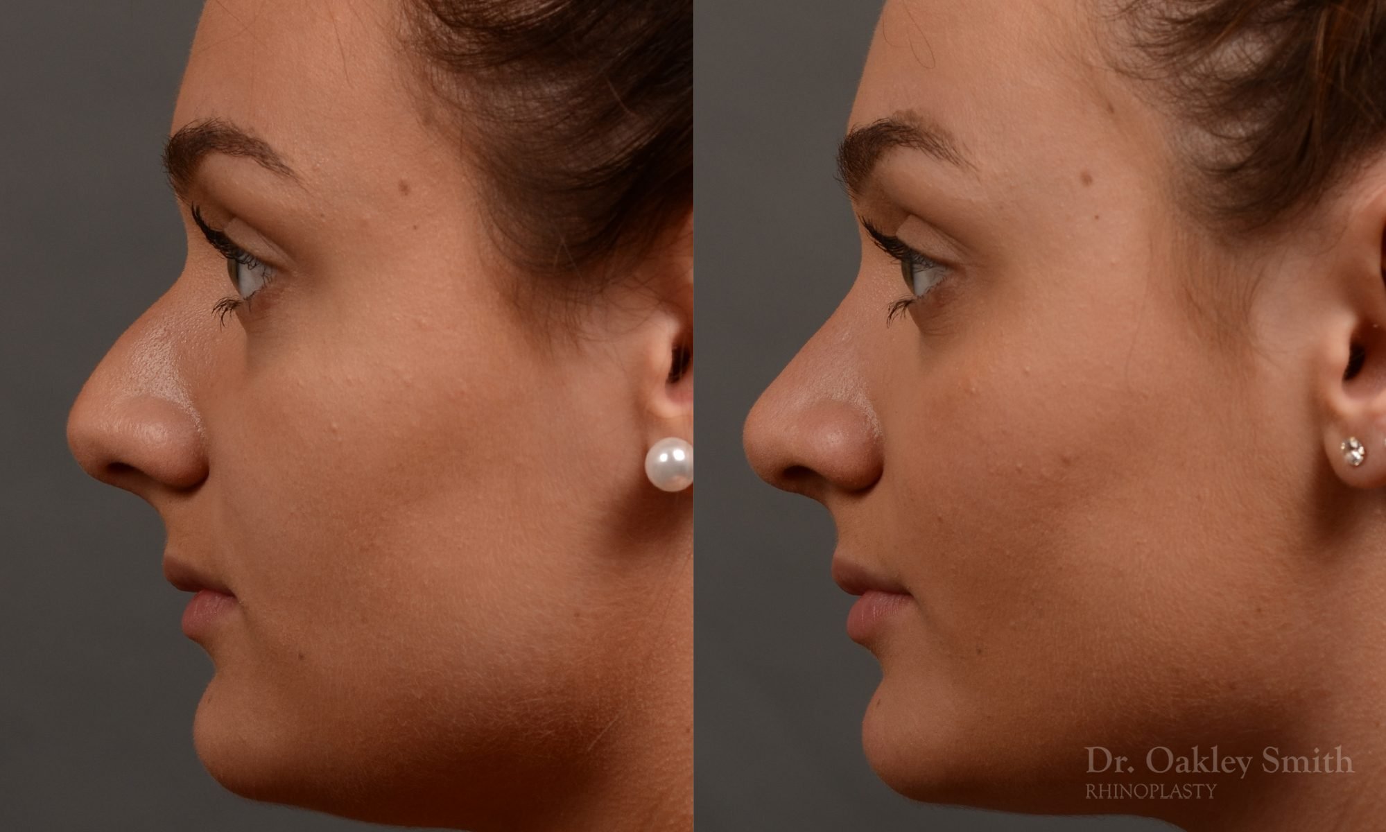 rhinoplasty Nothing demonstrates the skillful craftsmanship that Dr. Oakley Smith accomplishes during his surgeries than a collection of before and after case studies. As one of a hand full of surgeons in North America who limits his practice to only Rhinoplasty surgery, it is obvious that he has mastered his art. There is no question why he is one of the busiest cosmetic nose job surgeons in the country.
