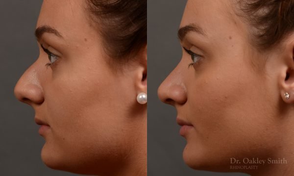 rhinoplasty Nothing demonstrates the skillful craftsmanship that Dr. Oakley Smith accomplishes during his surgeries than a collection of before and after case studies. As one of a hand full of surgeons in North America who limits his practice to only Rhinoplasty surgery, it is obvious that he has mastered his art. There is no question why he is one of the busiest cosmetic nose job surgeons in the country.