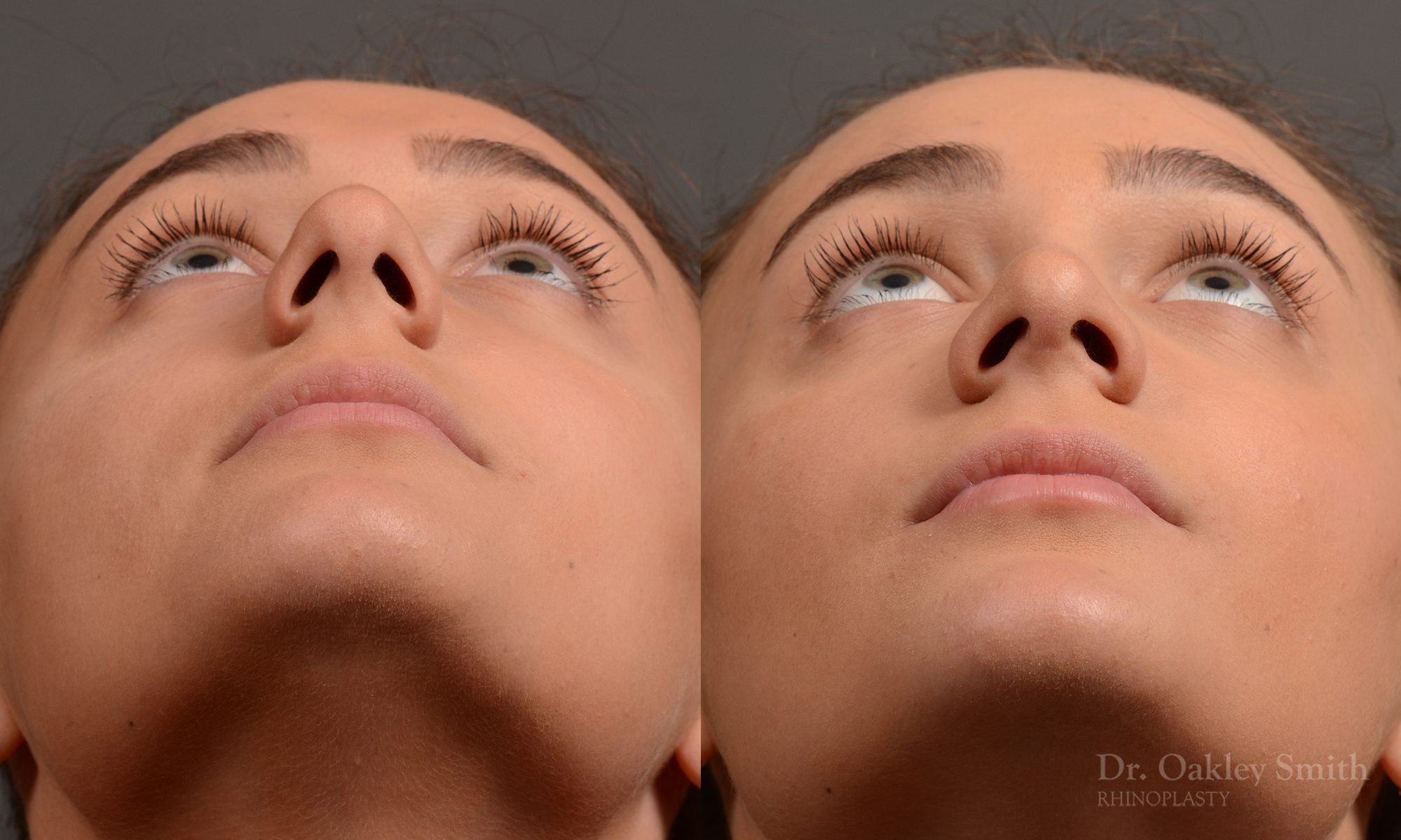 rhinoplasty Nothing demonstrates the skillful craftsmanship that Dr. Oakley Smith accomplishes during his surgeries than a collection of before and after case studies. As one of a hand full of surgeons in North America who limits his practice to only Rhinoplasty surgery, it is obvious that he has mastered his art. There is no question why he is one of the busiest cosmetic nose job surgeons in the country.