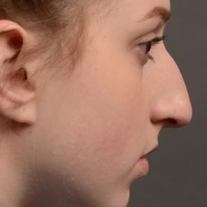 Expert Rhinoplasty nose job surgery to reduce the size of this womans nose.