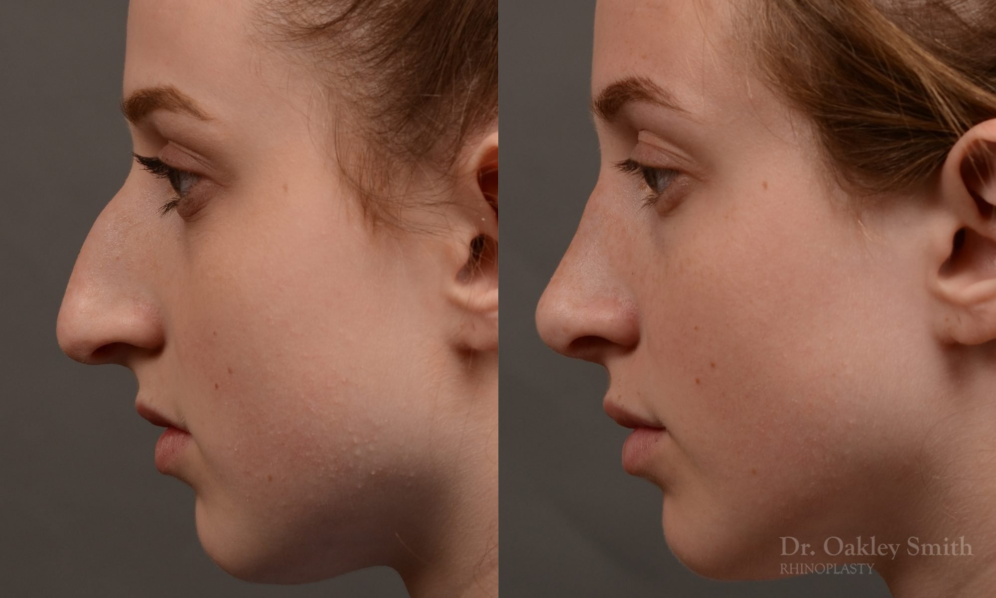 Expert Rhinoplasty nose job surgery to reduce the size of this womans nose.