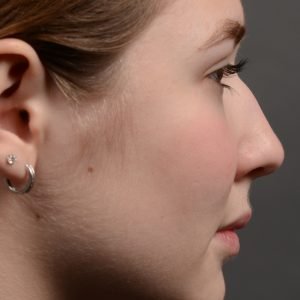 Expert Rhinoplasty nose job surgery to reduce the size of this womans nose.