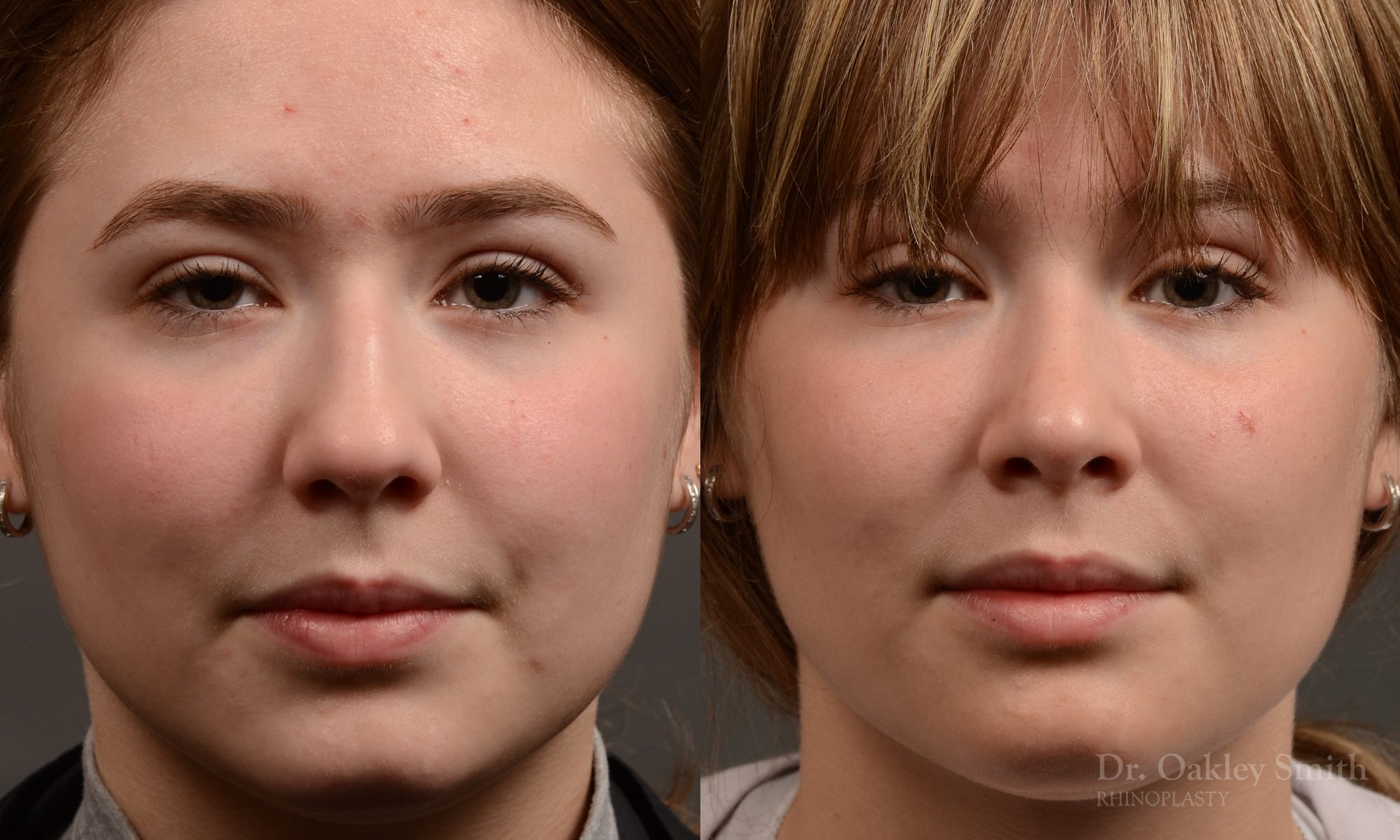 Expert Rhinoplasty nose job surgery to reduce the size of this womans nose.