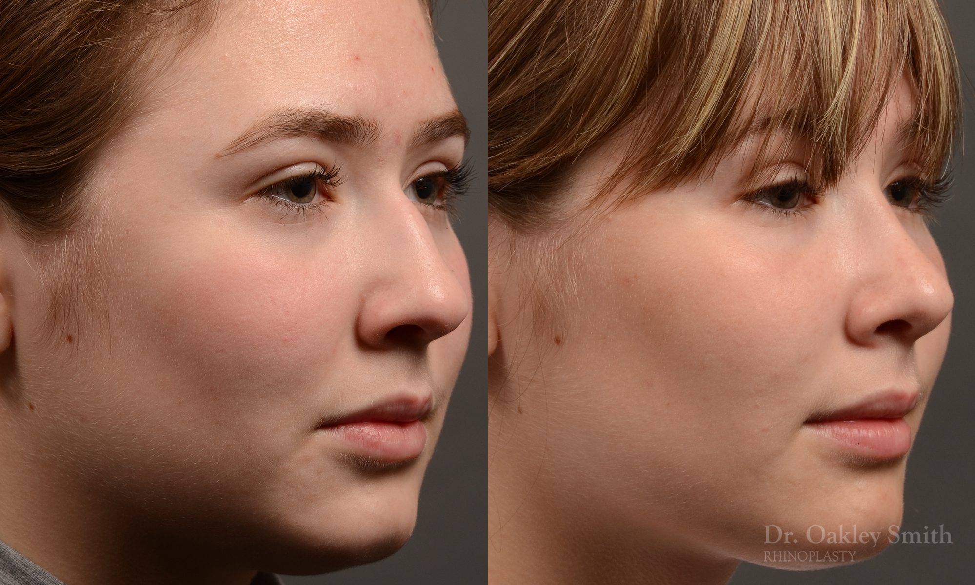 Expert Rhinoplasty nose job surgery to reduce the size of this womans nose.