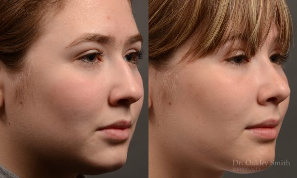 Expert Rhinoplasty nose job surgery to reduce the size of this womans nose.