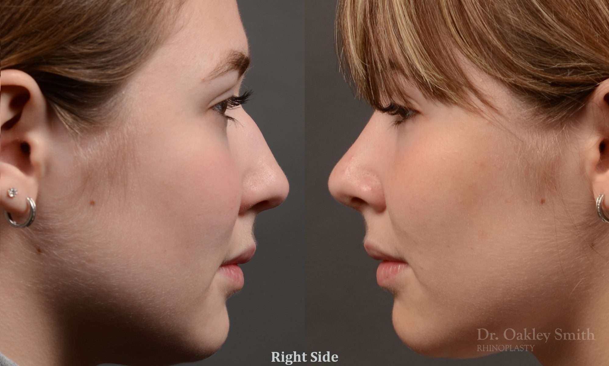 Expert Rhinoplasty nose job surgery to reduce the size of this womans nose.