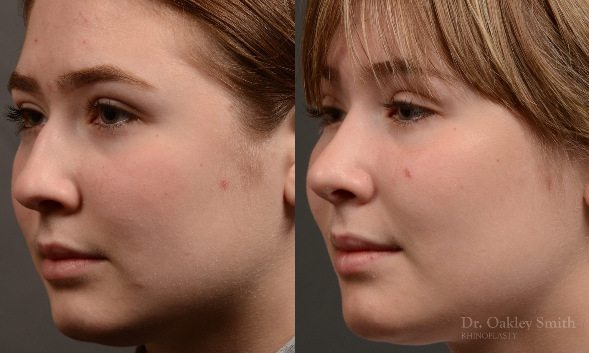 Expert Rhinoplasty nose job surgery to reduce the size of this womans nose.