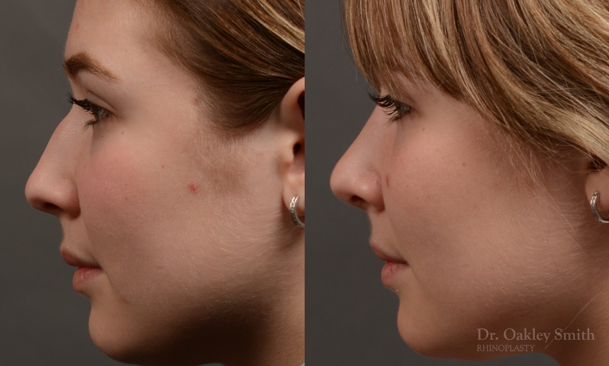 Expert Rhinoplasty nose job surgery to reduce the size of this womans nose.