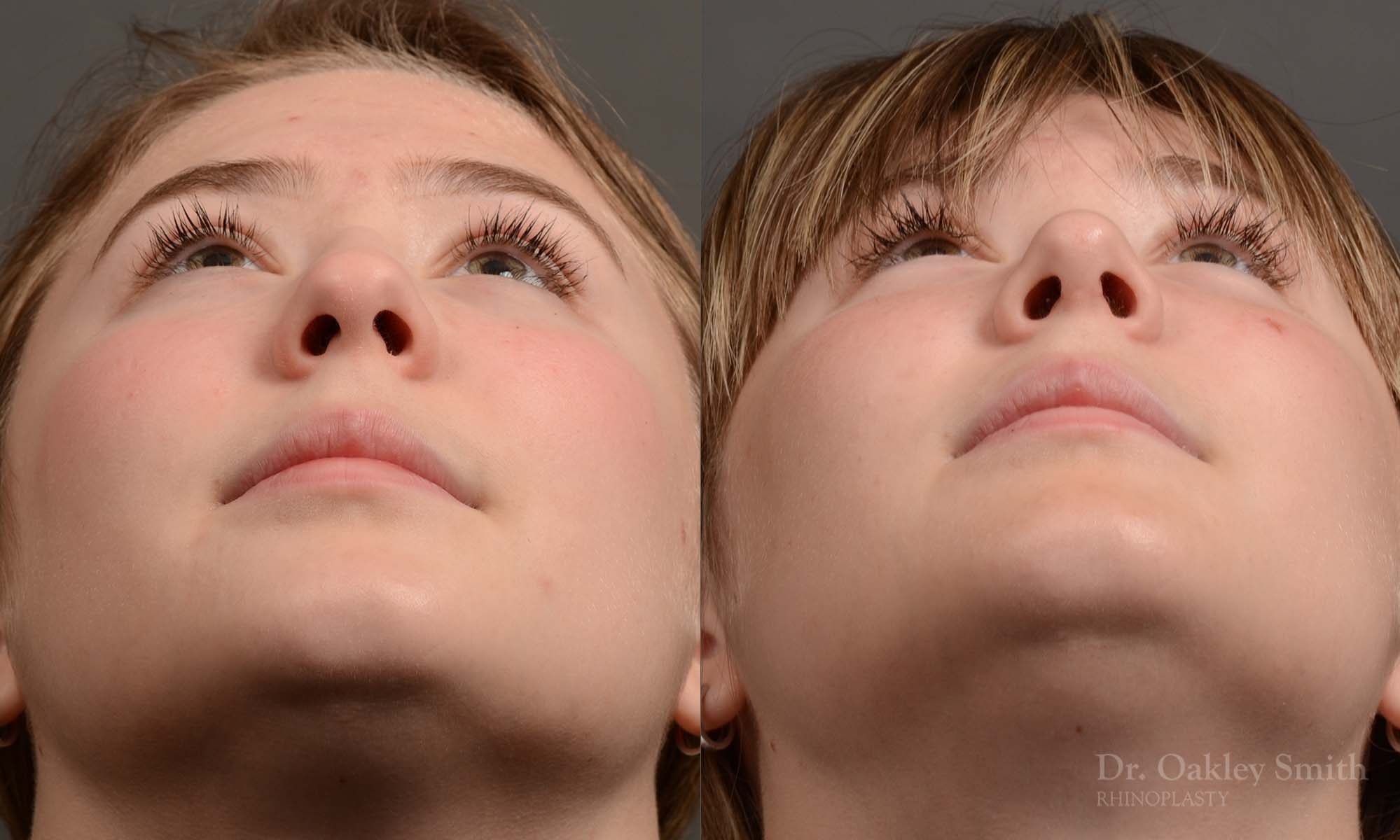 Expert Rhinoplasty nose job surgery to reduce the size of this womans nose.