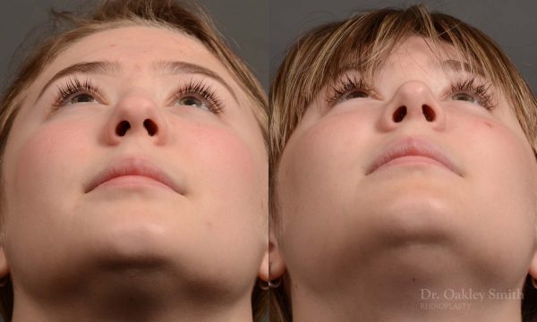 Expert Rhinoplasty nose job surgery to reduce the size of this womans nose.