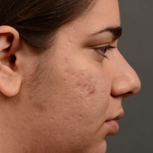 396 - Expert Rhinoplasty nose job surgery to reduce the size of this womans nose.