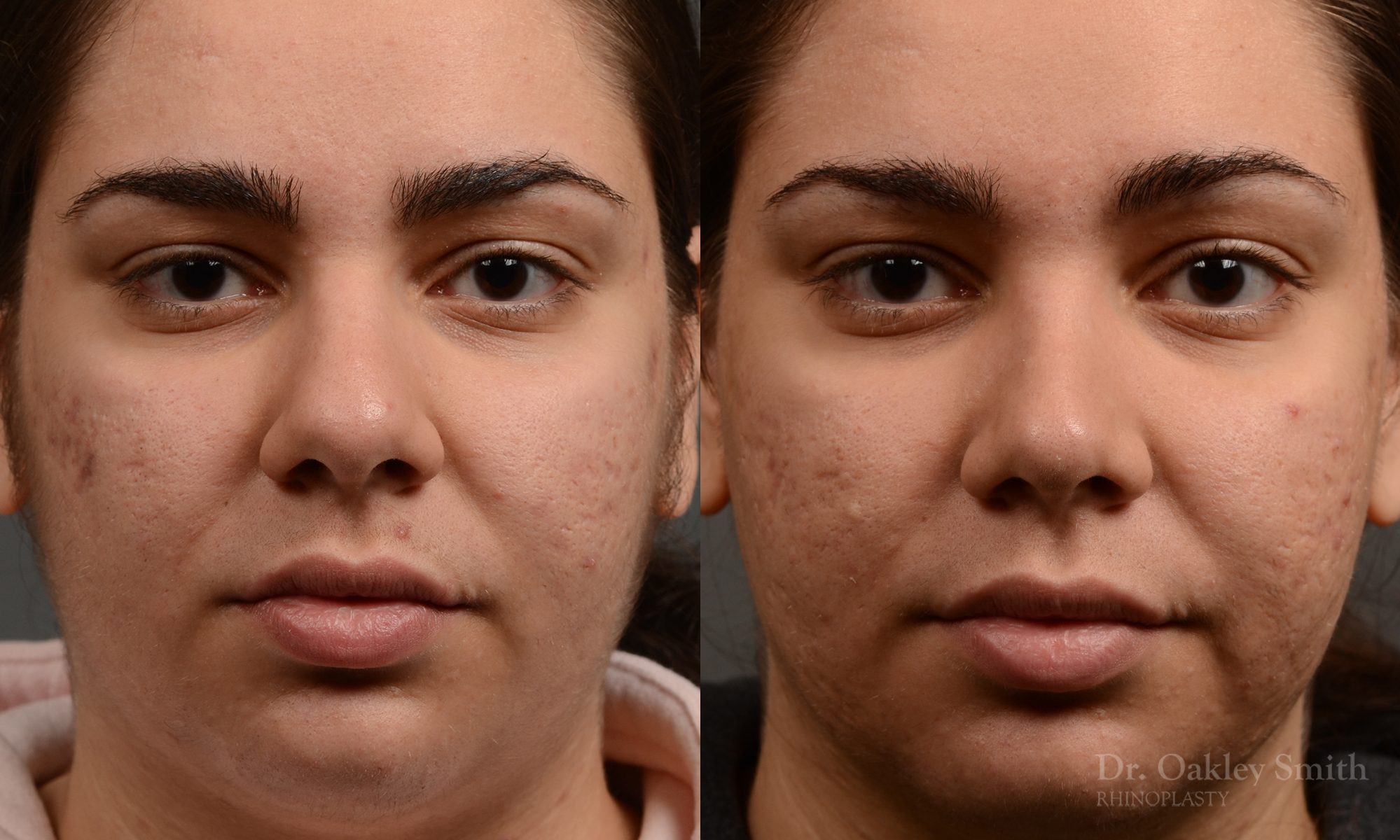 396 - Expert Rhinoplasty nose job surgery to reduce the size of this womans nose.