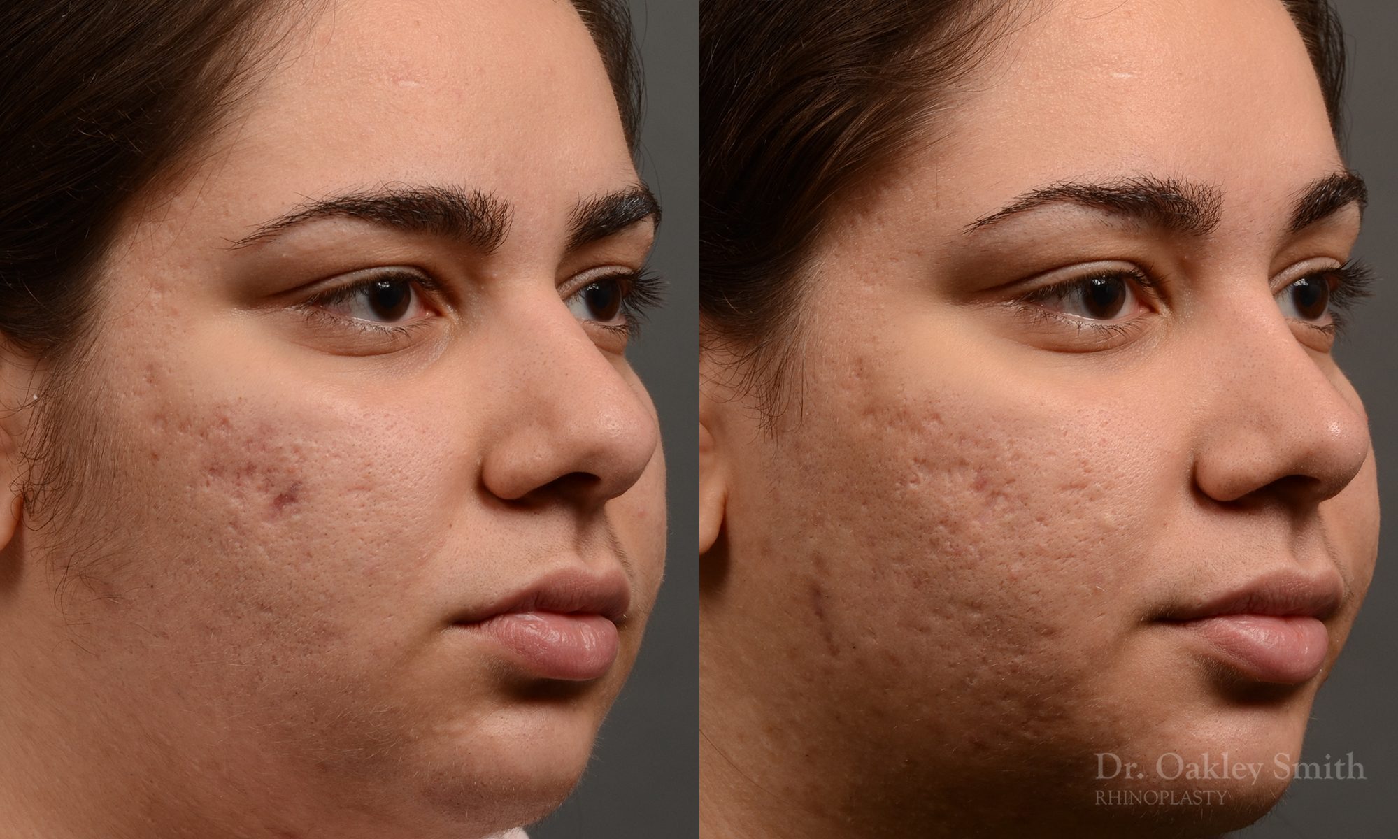 396 - Expert Rhinoplasty nose job surgery to reduce the size of this womans nose.