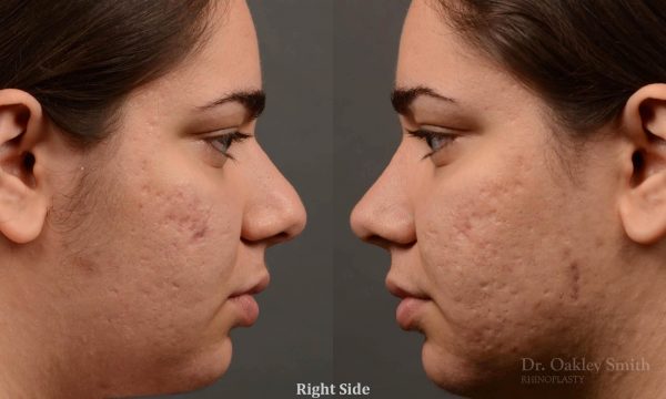 396 - Expert Rhinoplasty nose job surgery to reduce the size of this womans nose.