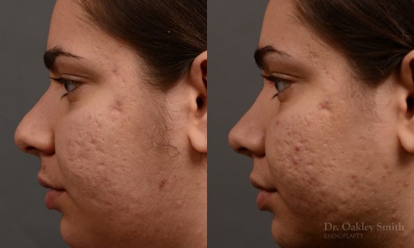 396 - Expert Rhinoplasty nose job surgery to reduce the size of this womans nose.