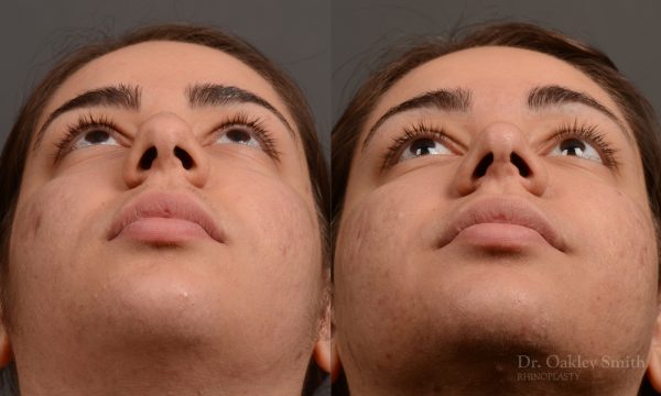 396 - Expert Rhinoplasty nose job surgery to reduce the size of this womans nose.