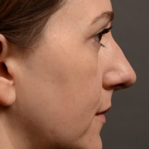 397 - Expert Rhinoplasty nose job surgery to reduce the size of this womans nose.