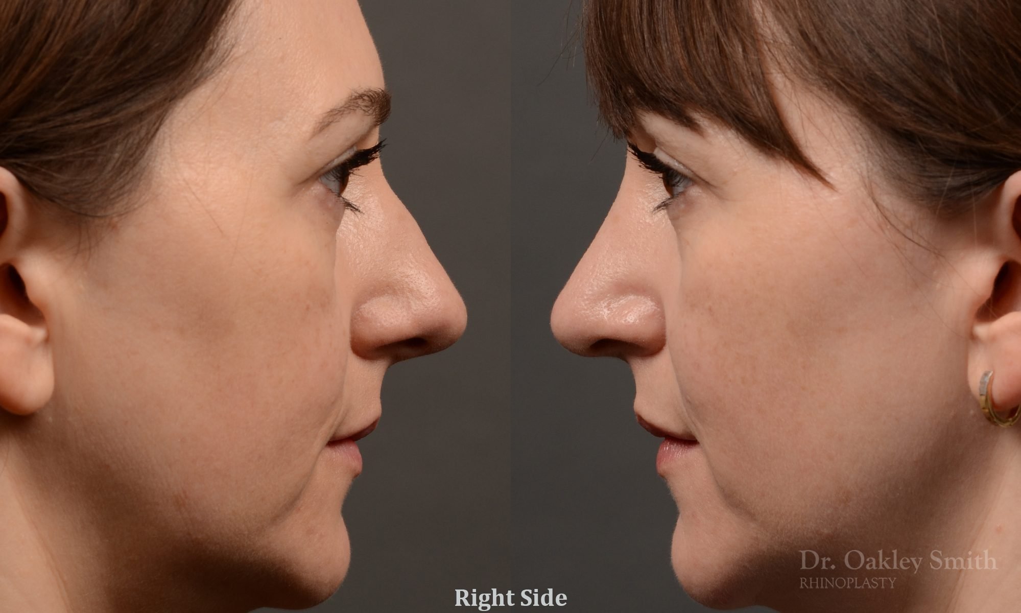 397 - Expert Rhinoplasty nose job surgery to reduce the size of this womans nose.