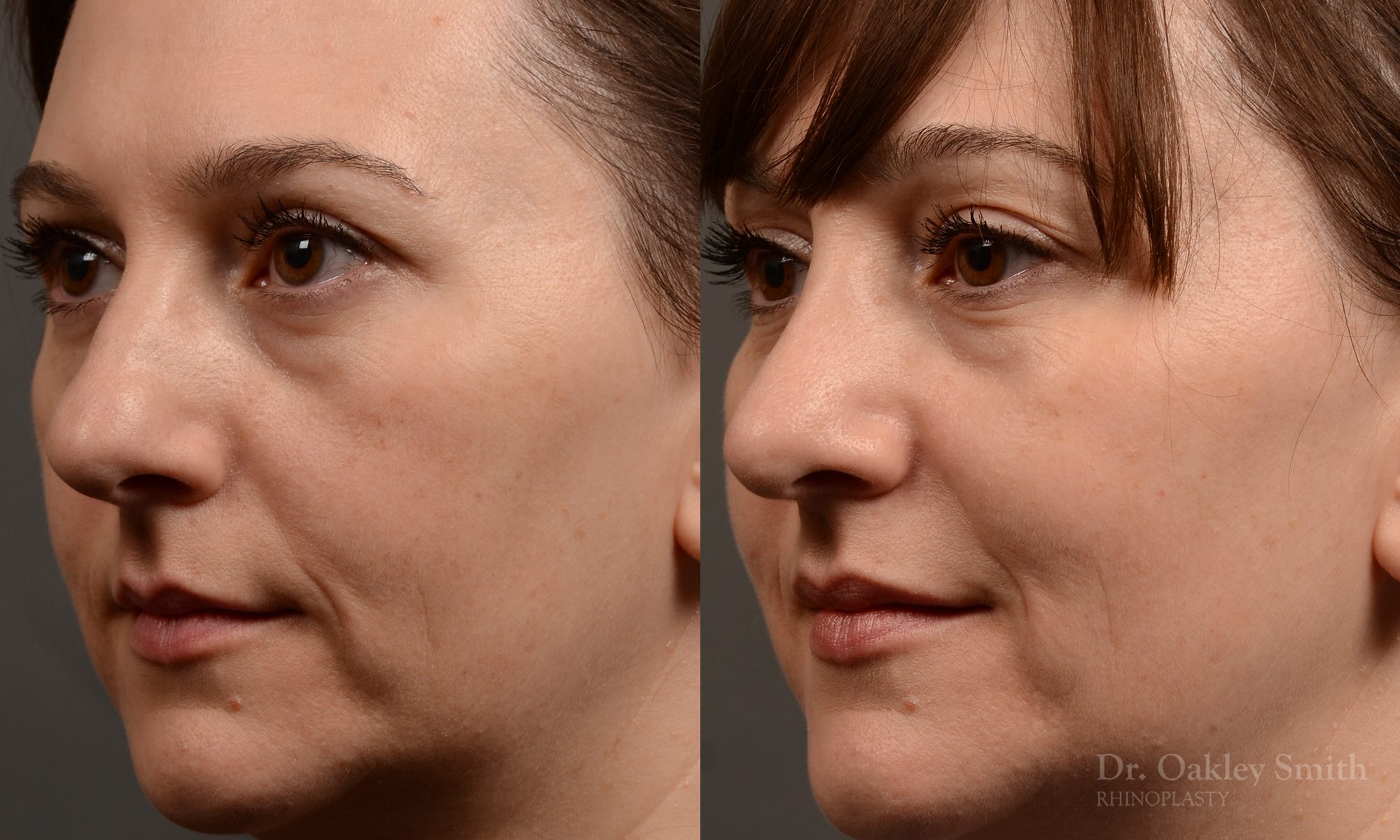 397 - Expert Rhinoplasty nose job surgery to reduce the size of this womans nose.