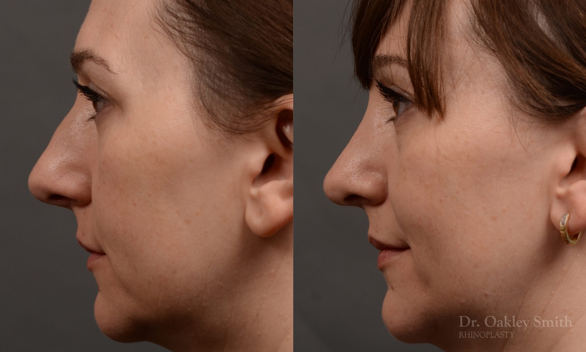 Rhinoplasty - 397 – Rhinoplasty Before and After Case 397