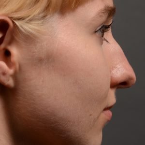 398 - Expert Rhinoplasty nose job surgery to reduce the size of this womans nose.
