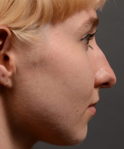 398 - Expert Rhinoplasty nose job surgery to reduce the size of this womans nose.
