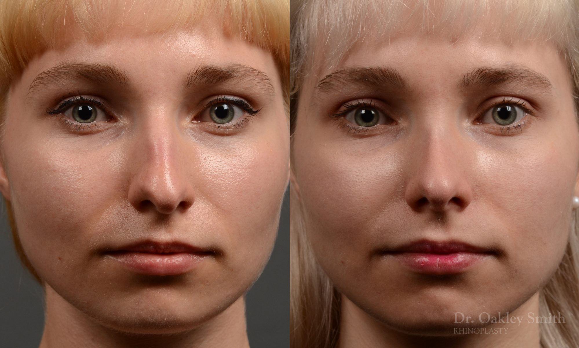 398 - Expert Rhinoplasty nose job surgery to reduce the size of this womans nose.