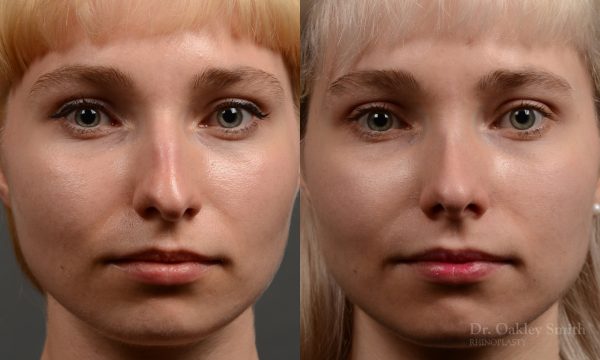 398 - Expert Rhinoplasty nose job surgery to reduce the size of this womans nose.