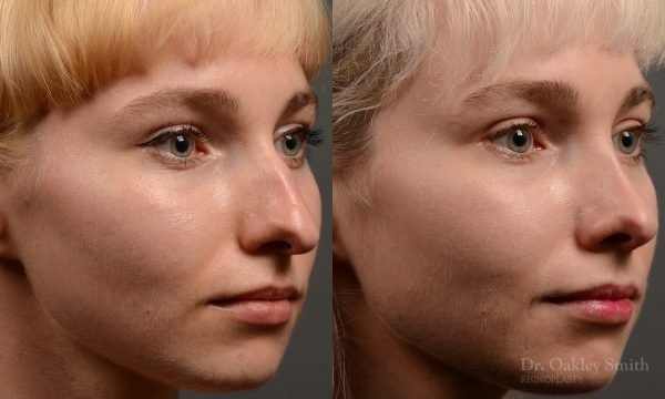 398 - Expert Rhinoplasty nose job surgery to reduce the size of this womans nose.