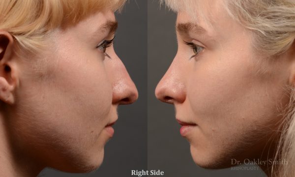 398 - Expert Rhinoplasty nose job surgery to reduce the size of this womans nose.