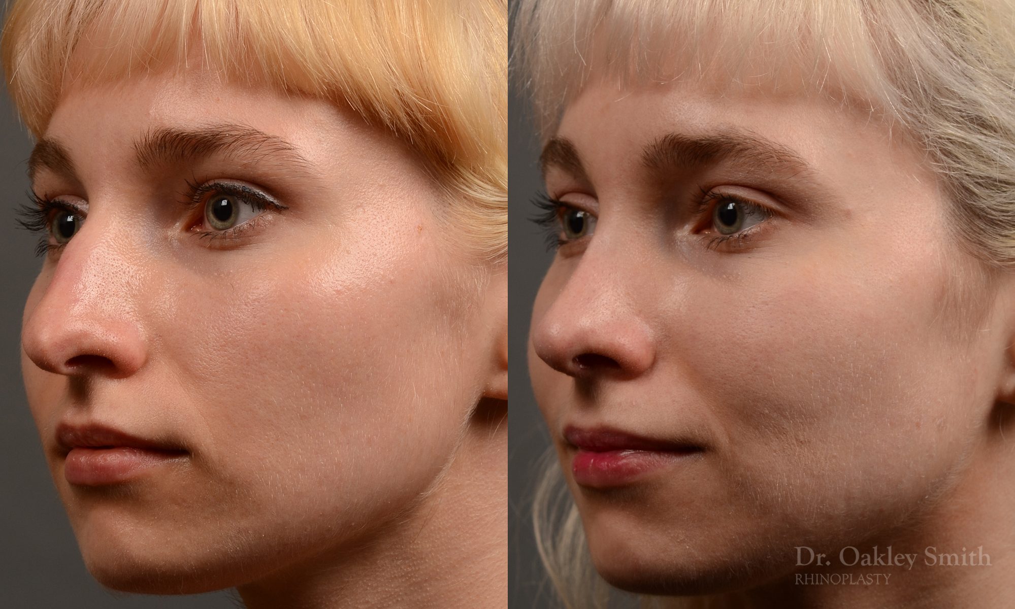 398 - Expert Rhinoplasty nose job surgery to reduce the size of this womans nose.